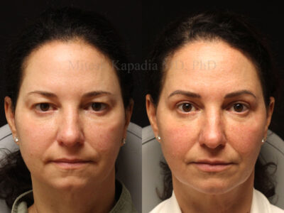 Woman in her 50s before and four months after upper blepharoplasty surgery giving her a younger appearance