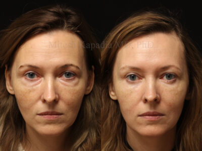 Woman in her 40s before and six months after lower blepharoplasty surgery giving her a less-tired, youthful appearance