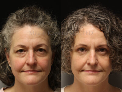 Woman in her 50s before and 2.5 months after upper and lower blepharoplasty surgery leaving the patient with a more youthful appearance