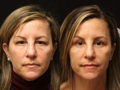 Woman in her 50s before and four months after upper and lower blepharoplasty surgery leaving her refreshed and younger looking
