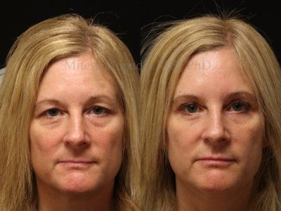 Woman in her early 50s before and after upper and lower blepharoplasty surgery, showing a less tired and rejuvenated look