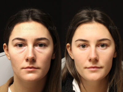 Woman in her 30s before and six months after lower blepharoplasty surgery giving her a well rested, natural appearance
