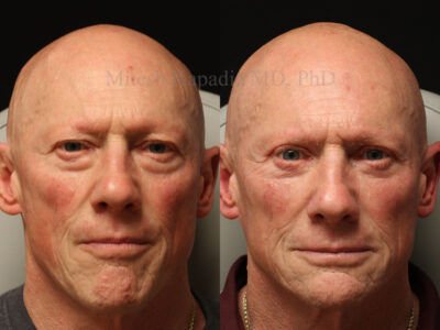 Man in his 60s before and three months after upper and lower blepharoplasty surgery leaving him with a well rested - youthful appearance
