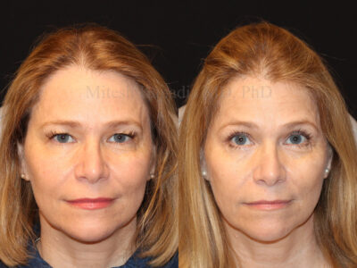 Woman in her 50s before and four months after upper blepharoplasty surgery giving her a less heavy - well rested appearance