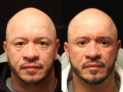 Man in his 50s eight months after upper and lower blepharoplasty surgery, giving him a more youthful yet natural appearance