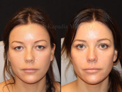 Woman in her 30s before and three months after upper blepharoplasty surgery giving her a brighter eyed more youthful appearance