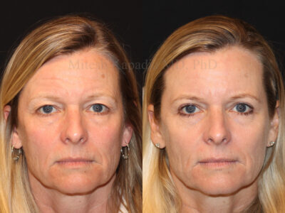 Woman in her 50s before and three months after upper blepharoplasty surgery making her look more youthful, and less tired