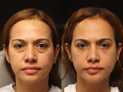 Woman in her early 40s before and six months after lower blepharoplasty surgery giving her a more refreshed appearance
