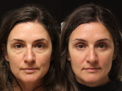 Woman in her mid 40s before and four months after lower blepharoplasty surgery leaving her refreshed and less tired looking