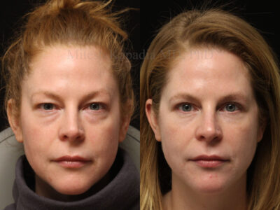 Woman in her early 40's before and six months after upper and lower blepharoplasty surgery