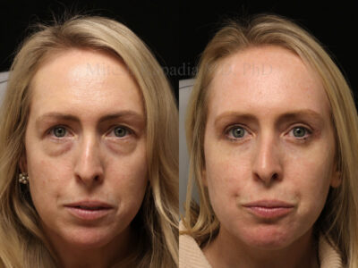 Woman in her 30s before and ten months after upper and lower blepharoplasty surgery making her look younger and refreshed