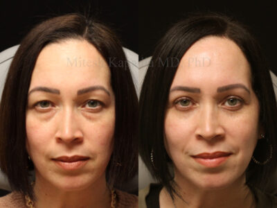 Woman in her 40's before and 18 months after upper and lower blepharoplasty surgery giving her a more refreshed & youthful appearance