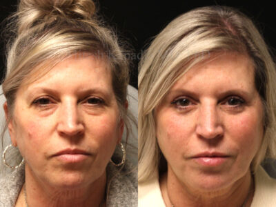 Woman in her 50's before and six months after upper and lower blepharoplasty surgery