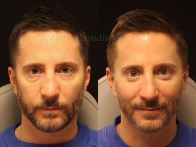 Man in his 40's before and seven months after lower blepharoplasty surgery