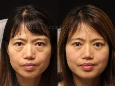 Woman in her early 50's before and six months after lower blepharoplasty surgery