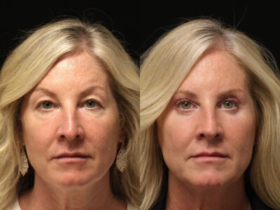 Woman in her early-50s before and six months after upper and lower blepharoplasty surgery