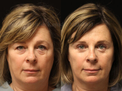 Woman in her early-50s before and six months after upper and lower blepharoplasty surgery with lower eyelid CO2 laser resurfacing