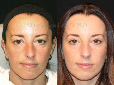 Woman in her early 40's before and six months after upper blepharoplasty surgery giving her a youthful open-eyed appearance.