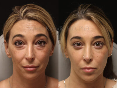 Woman in her early 40's before and six months after lower blepharoplasty surgery giving her a natural refreshed look