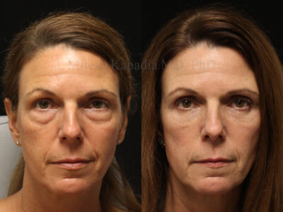 Woman in her mid 50's before and six months after lower blepharoplasty surgery
