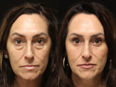 Woman in her early 50's before and six months after lower blepharoplasty surgery and lower eyelid CO2 laser resurfacing