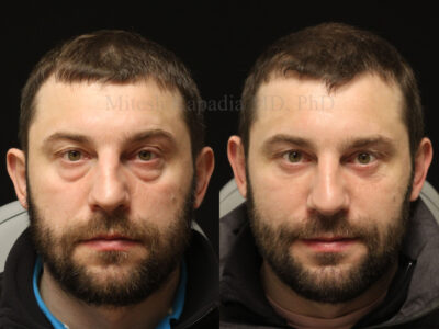 Man in his late 30's before and six months after lower blepharoplasty giving him a more vibrant and refreshed look.