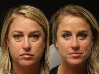 Woman in her mid 30's before and eight months after upper and lower blepharoplasty surgery.