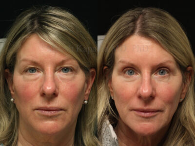 Woman in her early 60's before and after upper and lower blepharoplasty surgery with lower eyelid CO2 laser.