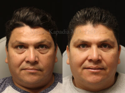 Man in his mid 40's before and six months after lower blepharoplasty surgery.