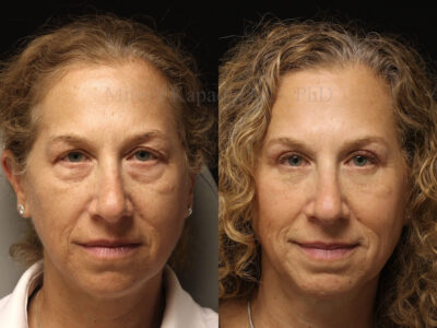 Woman in her mid 50's before and six months after upper and lower blepharoplasty surgery