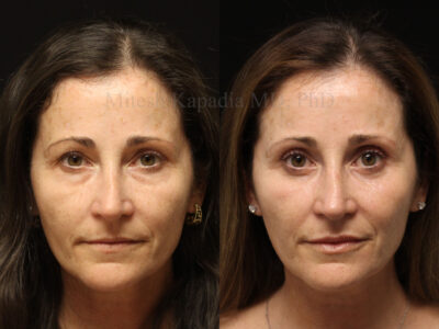 Woman in her 50's before and six months after upper and lower blepharoplasty surgery.