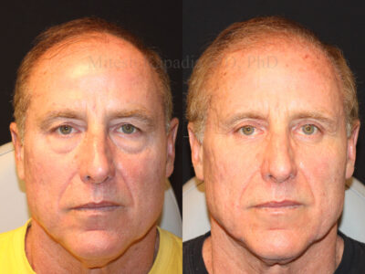Man in his late 60's before and six months after upper and lower blepharoplasty surgery.