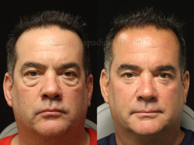 Man in his late 50's before and six months after lower blepharoplasty surgery.