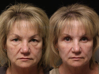 Woman in her early 60's six months after upper and lower blepharoplasty with lower lid CO2 laser resurfacing.