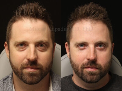 Man in his early 40's before and nine months after lower blepharoplasty surgery