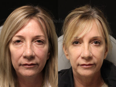 Woman in her late 50's before and six months after lower blepharoplasty surgery and lower eyelid CO2 laser resurfacing.