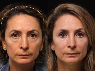 Woman in her late 40's before and six months after revisional lower eyelid blepharoplasty.