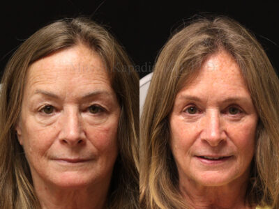 Woman in her early 60's before and 1.5 years after upper and lower blepharoplasty surgery.