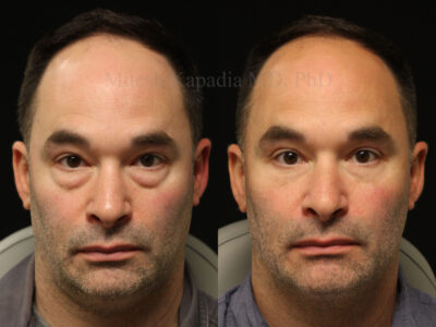 Man in his early 40's before and six months after lower blepharoplasty surgery.