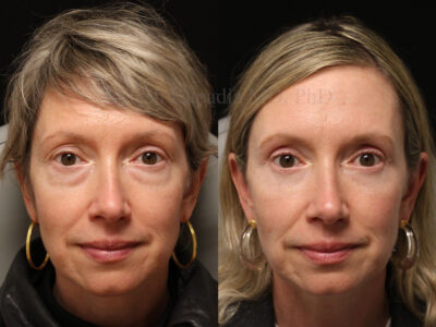 Woman in her 50's before and six months after upper and lower blepharoplasty surgery.