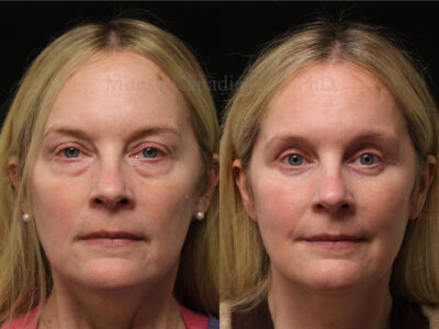 Woman in her 50's before and six months after lower blepharoplasty and upper nasal fat pad removal surgery.