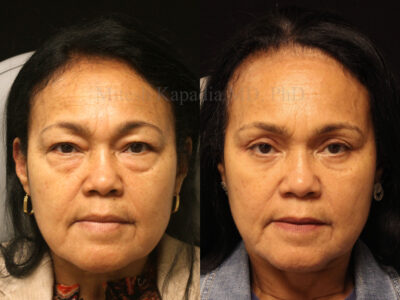 Woman in her early 60's before and six months after upper and lower blepharoplasty.