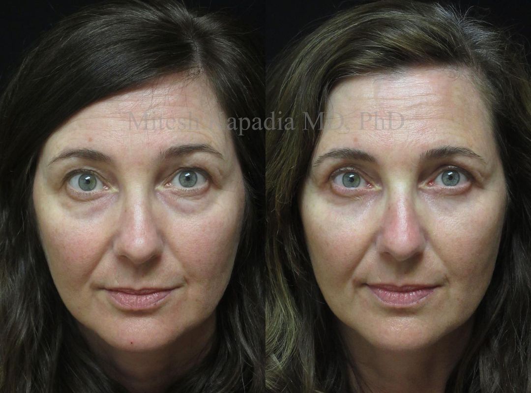 Patient with advanced dermatochalasis