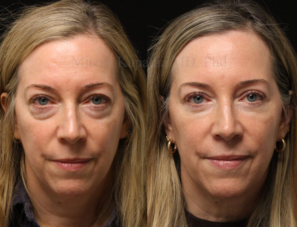 Before And Six Months After Lower Blepharoplasty Surgery And Lower 