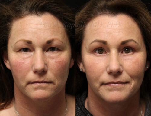 Before and 6 months after upper and lower blepharoplasty surgery with lower lic CO2 laser resurfacing