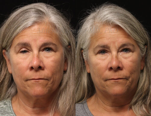 Before and 6 months after right eyelid ptosis repair