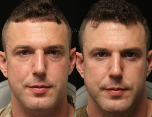 Before and 6 months after lower blepharoplasty surgery