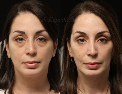 Before and 9 months after lower blepharoplasty surgery with lower lid CO2 laser resurfacing