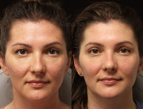 Before and 3 months after upper eyelid blepharoplasty surgery