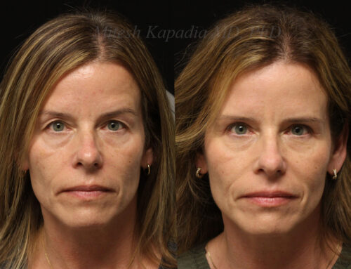 Before and 6 months after upper blepharoplasty surgery